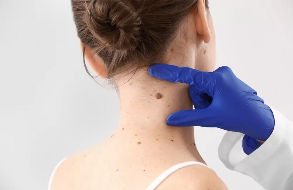 Best Miami Skin Tag Removal Near You Dermatologist for Removal of
